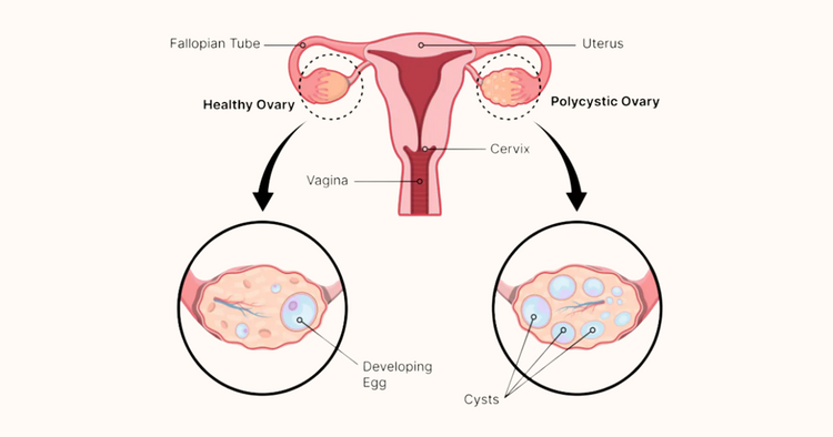 What is Polycystic Ovary Syndrome (PCOS)? – Blushproof