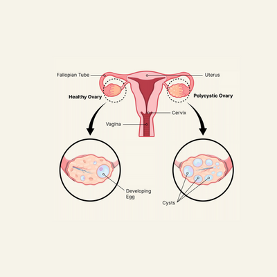 What is Polycystic Ovary Syndrome (PCOS)?